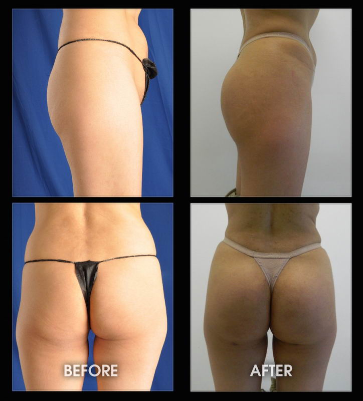 https://www.lafayettecosmeticsurgeon.com/wp-content/uploads/2020/11/before-after-buttock-implant-03.jpg