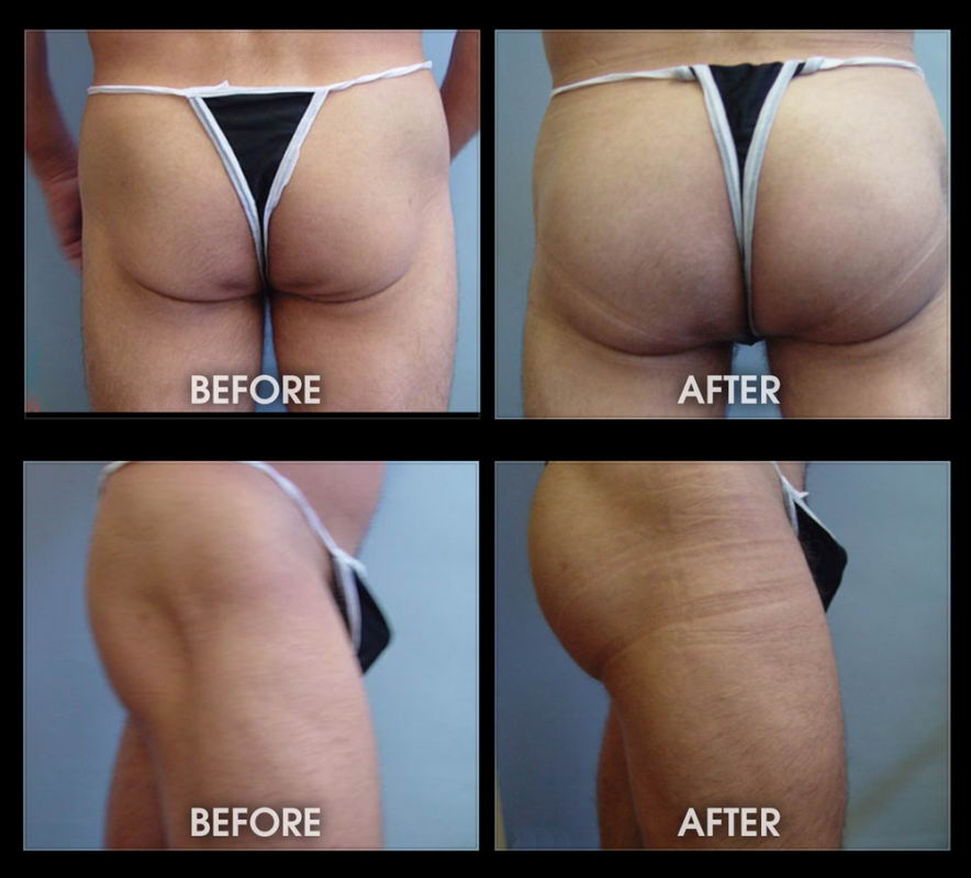 Before & After Buttock Augmentation Gallery - Cosmetic Surgery, Lafayette